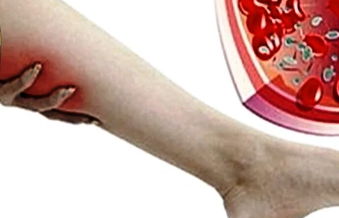Bacaktaki varisli damarlar